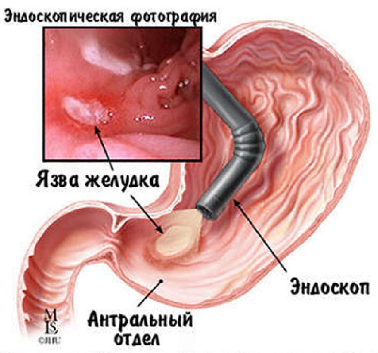 Гастроскопия желудка гастрит